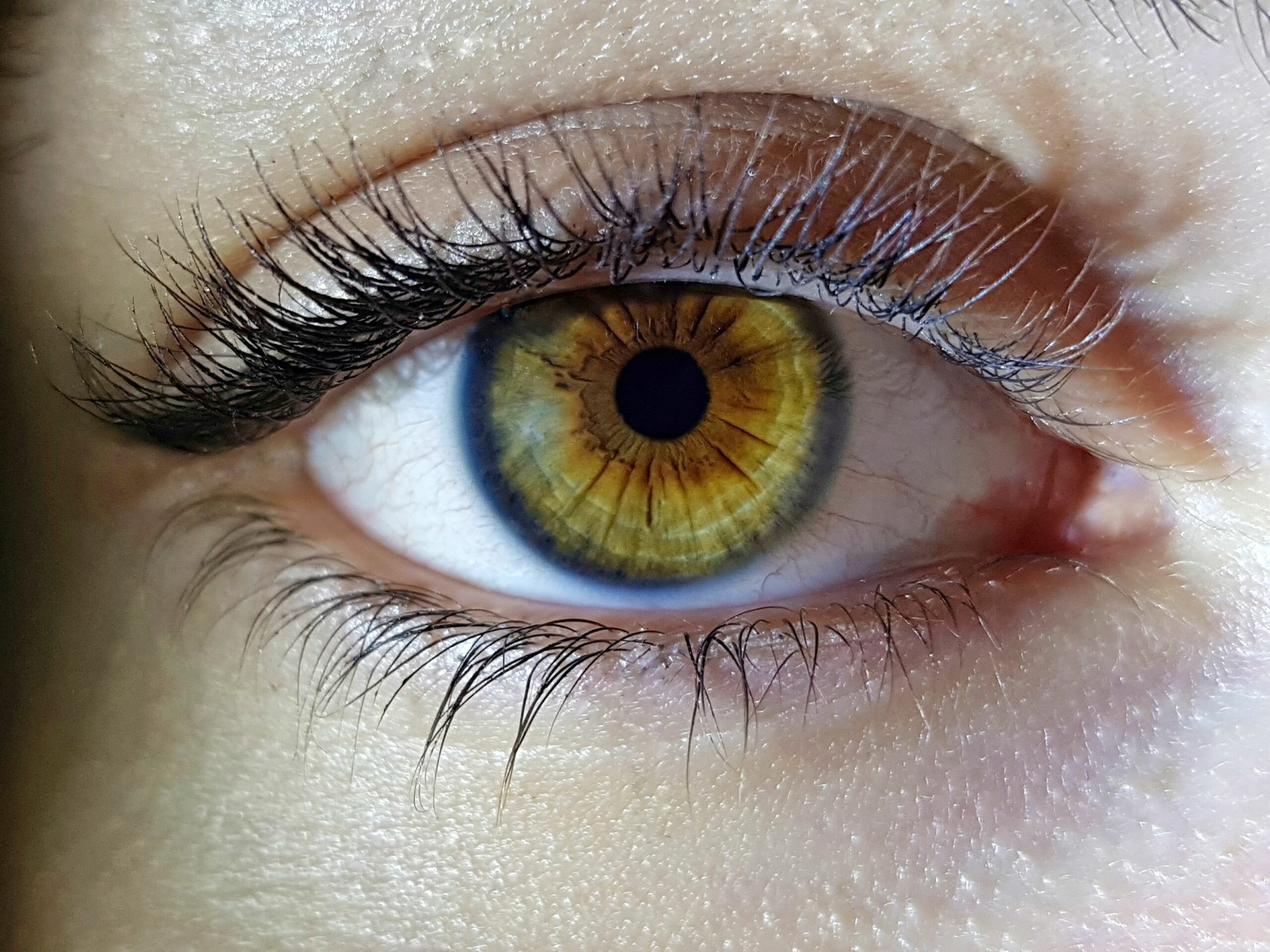 Femto-LASIK